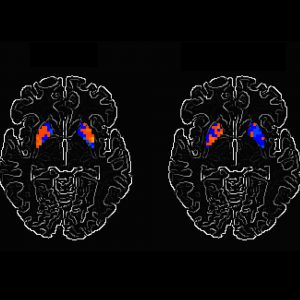 Functional magnetic resonance imaging of a brain